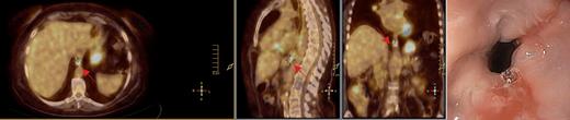 Sixty-two-year-old woman was submitted to 18Fluorine-FDG PET/computer tomography in the context of surveillance of a melanoma. There was incidental FDG uptake in the lower esophagus. The patient underwent upper endoscopy, which showed a reflux esophagitis. Fused PET/CT image showing FDG uptake (standardized uptake value, SUVmax 9.8) in the lower esophagus (arrow) in axial, coronal and sagittal planes. Upper endoscopy image showed the Los Angeles grade C esophagitis.