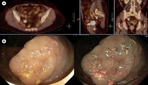 Sixty eight-year-old man was submitted to 18Fluorine-FDG PET/computer tomography in the context of a hematological disorder. There was incidental FDG uptake in the ascending colon. The patient underwent colonoscopy, which showed a tubulo-villous adenoma which harbors high-grade dysplasia. a Fused PET/CT image showing FDG uptake (standardized uptake value, SUVmax 9.8) in the ascending colon (arrow) in axial, coronal and sagittal planes. b Colonoscopy image showed a lateral spreading tumor granular homogenous type in white light and narrow band image.