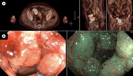 Seventy two-year-old man was submitted to 18Fluorine-FDG PET/computer tomography in the context of a hematological disorder. There was incidental FDG uptake in the right colon. The patient underwent colonoscopy, which showed an adenocarcinoma. a Fused PET/CT image showing FDG uptake (standardized uptake value, SUVmax 17.9) in the ascending colon (arrow) in axial, coronal and sagittal planes. b Colonoscopy image showed a lateral spreading tumor granular homogenous type in White Light and Narrow Band Image.