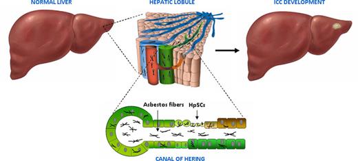 Trapped asbestos fibers within smaller bile ducts, particularly at the level of the canals of Hering, where they may exert carcinogenic effects, inducing HpSC malignant transformation and eventually ICC development. Reproduced with permission, MDPI, Basel, Switzerland (https://creativecommons.org/licenses/by/4.0), Brandi G, Tavolari S. Asbestos and intrahepatic cholangiocarcinoma. Cells 2020;9.