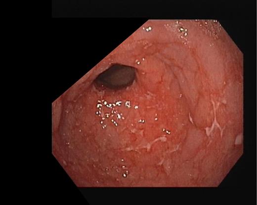 Gastric antrum with ulcers on upper gastrointestinal endoscopy, before stopping olmesartan.