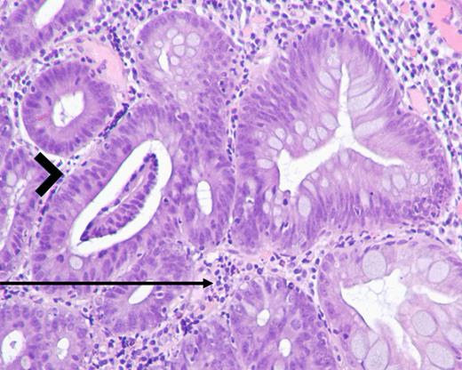 Histopathological findings of gastric mucosa prior to discontinuing olmesartan, stained with hematoxylin and eosin (H&E), at ×100 magnification. Inflammatory infiltrate in the lamina propria (arrow), indicative of gastritis, and low-grade dysplasia (arrowhead) were present.