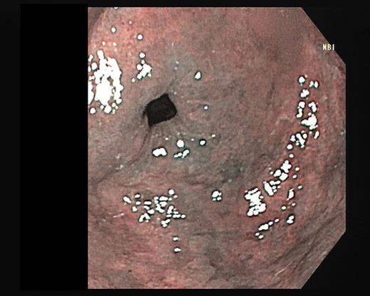 Gastric antrum visualized using narrow band imaging (NBI) during upper gastrointestinal endoscopy, after stopping olmesartan.