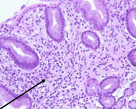 Histopathological findings of gastric mucosa after discontinuation of olmesartan, stained with hematoxylin and eosin (H&E), at ×100 magnification. A reduction in the inflammatory infiltrate (arrow) was observed, indicating histological improvement.