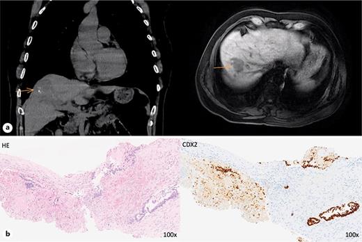 a Two liver nodules with 1.8 cm and 3.7 cm detected on CT/MRI after 8 years of follow-up. b Surgical pathology confirmed metastases of colorectal adenocarcinoma after liver resection.