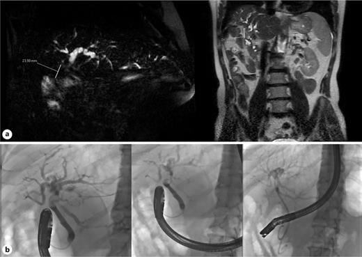 a MRCP revealed a 2.4 cm intraductal lesion resulting in left hepatic duct stenosis, without parenchymal liver nodules. b ERCP confirmed the proximal common bile duct/left hepatic duct stenosis, and biliary drainage was accomplished with plastic stents. MRCP, magnetic resonance cholangiopancreatography.