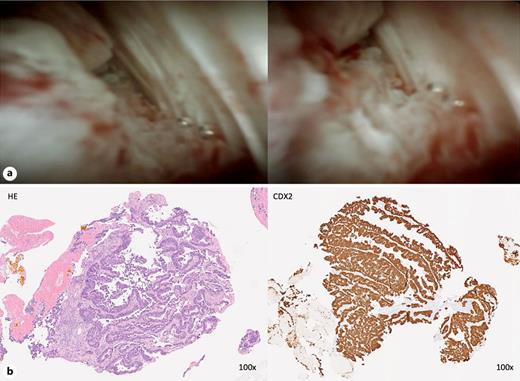 a Cholangioscopy showed villous mucosa surrounded by irregular vessels suggestive of tumor neovascularization. b SpyBite™ biopsies revealed biliary metastasis, and immunohistochemistry was positive for CDX2, CK20, and SMAD4 being suggestive of colorectal origin.