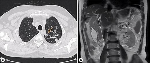 a Thorax CT showing a 17-mm lung nodule suggestive of metastasis. b MRI showing a 120-mm diffuse infiltrating intraductal biliary lesion.