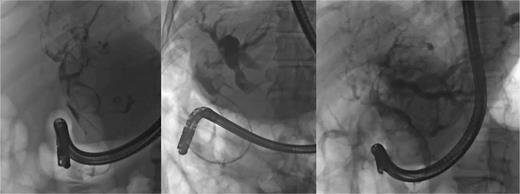 ERCP was performed for biliary drainage – several nodular and pseudopolypoid defects could be observed in the cholangiography obliterating the bile duct from the hilum to the ampulla. Given the lesion extension and gastric compression by the hypertrophied liver leading to duodenoscope mispositioning, transpapilar stents could not be deployed to overcome the stenosis.