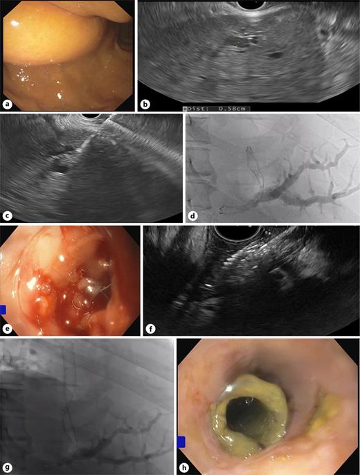 a EUS access was limited by gastric bulging. b Dilated intrahepatic duct (5.8 mm). c Intrahepatic duct puncture with a 19G needle. d Partially covered SEMS (GIOBOR™ 8 × 100 mm) on fluoroscopy. e Proximal flare of the SEMS incidentally deployed in a 3-cm intraparietal esophageal tract. f The misplaced stent was recanalized through EUS. g Stent-in-stent FCSEMS (WallFlex™ 80 × 10 mm). h Hepaticoesophagostomy on endoscopy. SEMS, self-expandable metal stent; FCSEMS, fully covered self-expandable metal stent.