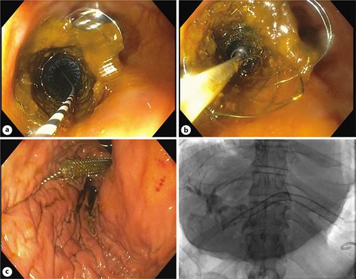 a Placement of a third stent-in-stent NCSEMS (WallFlex™ 120 × 10 mm). b Inflated biliary balloon to help placing the proximal flare oriented to the stomach. c Proximal flare of the SEMS oriented to the stomach on endoscopy and fluoroscopy. SEMS, self-expandable metal stent. NCSEMS, non-covered self-expandable metal stent.