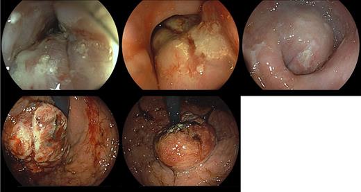 EGD reveals the presence of an extensive and eccentric lesion starting at 30 cm from the dental arch, occupying approximately half of the luminal circumference at the level of the distal esophagus. There is circumferential involvement of the esophagogastric junction and the cardia, with infiltration of the mucosa and extensive ulceration and friability.