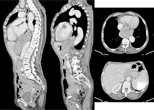 Cervical-thoracic-abdominopelvic computed tomography scan showing a solid and heterogeneous expansive lesion, starting at the level of D8-D9 and extending caudally for approximately 14 cm, reaching the cranial portion of the gastric fundus with contact with the thoracic aorta and posterior cardiac chambers. Additionally, a voluminous adenopathy is observed in the region of the celiac trunk.