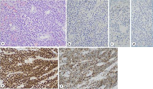Anatomopathological evaluation. a H&E 200×, a neoplasm composed of epithelioid cells with scattered apoptotic bodies, is seen. b No immunostaining for AE1/AE3 was seen. c CD20 was negative. d CD3 was also negative. e Diffuse nuclear positivity for SOX10 is seen. f Diffuse cytoplasmatic positivity for Melan-A.
