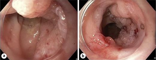 a, b Laterally spreading tumor with involvement of 70% of the rectum circumference.