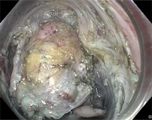 Severe submucosal fibrosis with identification of surgical clips.