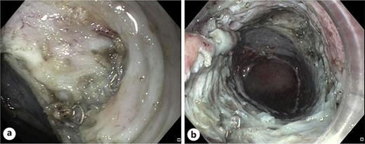 a, b Intermuscular dissection in areas with severe fibrosis and surgical clips.