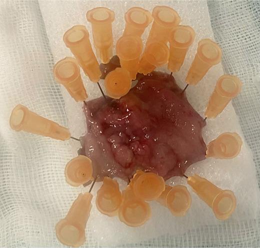 Rectal lesion after EID.