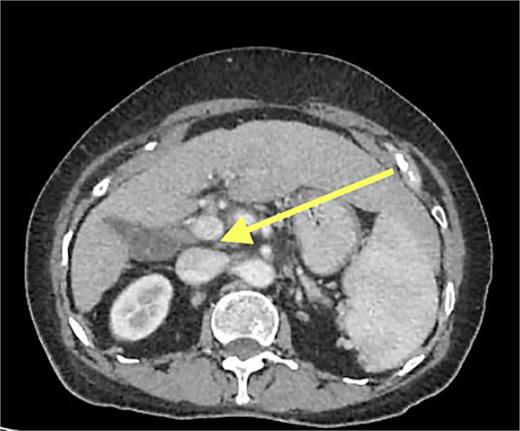 CT image showing extrahepatic portal venous compression by lymph nodes.