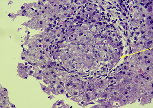Histopathologic image of granuloma in the liver, hematoxylin and eosin (H&E), ×400.