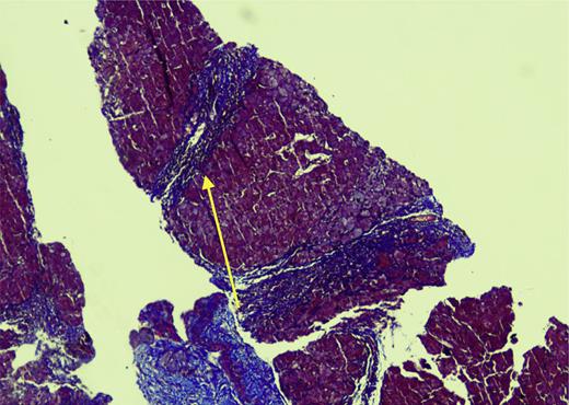 Histopathology of the liver showing bridging fibrosis, Masson’s trichrome (MT), ×200.