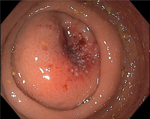 Endoscopic image of rectal neoplasia.
