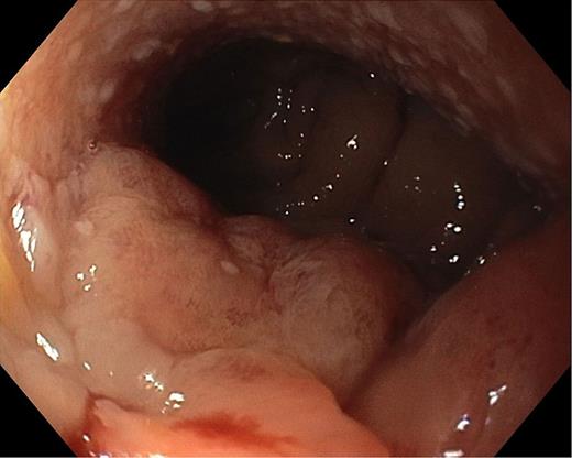 Endoscopic image of rectal neoplasia.
