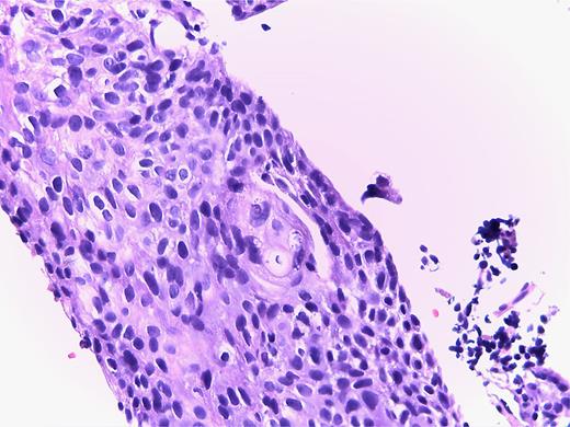 HE, squamous cell carcinoma. No evidence of glandular differentiation.