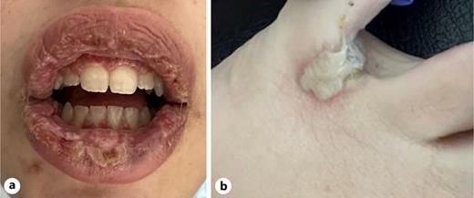 Mucocutaneous lesions, case 1. a Oral ulcers. b Ulcers on toes.