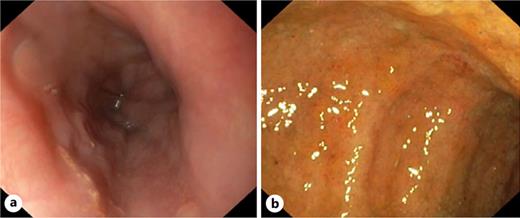 Endoscopic findings, case 1. a Pleomorphic lesions in the esophagus. b Edema, erythema, and friability of the colonic mucosa.
