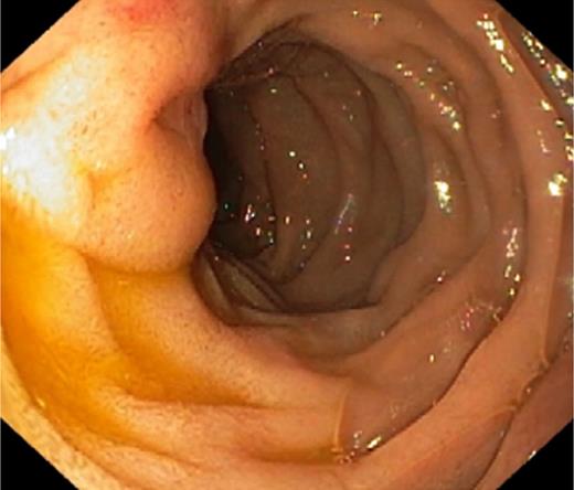 Esophagogastroduodenoscopy, case 2: mucosal edema of the papilla of Vater.