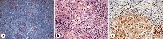 Histologic examination. ×100 trichrome (a) showing regenerative nodules and significant necrosis between the nodules. ×400 hematoxylin and eosin (b) revealing that the remaining hepatocytes exhibit marked ballooning degeneration with numerous Mallory-Denk bodies, accompanied by a mixed inflammatory infiltrate. Rhodamine staining (×400) (c) demonstrates significant copper deposition (arrows). While these findings are nonspecific, they raise the suspicion of Wilson’s disease.