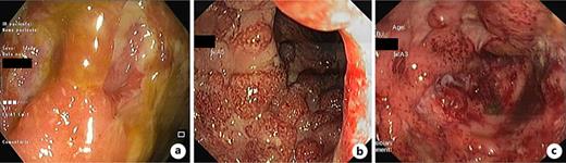 Endoscopic images illustrating deep ulcers in ASUC. a Deep ulceration in the descending colon with fibrin-covered lesions. b, c Deep ulcers in the rectum with extensive mucosal loss.