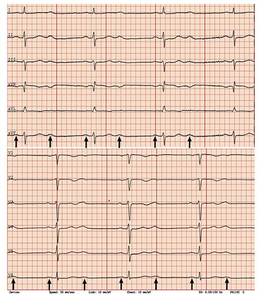 Fig. 1. ECG taken on admission showing sinus rhythm with 2:1 atrioventricular block (black arrows indicating p-waves), left axis deviation, and poor R-wave progression.