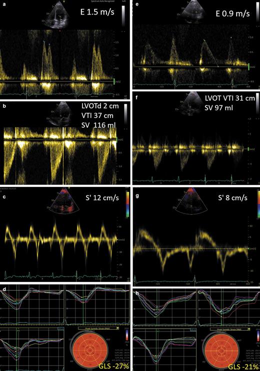 Fig. 2. Initial echocardiography demonstrating increased LV filling with an E wave &gt;1.5 m/s (a), LV stroke volume of 116 mL (b), systolic tissue Doppler velocity with a medial S’ of 12 cm/s (c), and GLS of −27% (d). Echocardiography after pacemaker implantation (e–h) showing a reduction in LV filling (e) with an E-wave of 0.9 m/s, a smaller stroke volume (f), medial S` of 8 cm/s (g), and a reduction in GLS to −21% (h) compared with initial echocardiography.