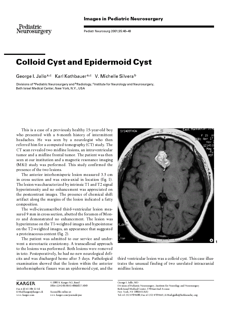 First page of Colloid Cyst and Epidermoid Cyst