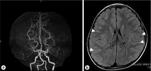 Fig. 1. a MRA shows stenosis of the bilateral internal carotid arteries. b FLAIR image demonstrates the ivy sign bilaterally (arrowheads). FLAIR, fluid-attenuated inversion recovery.