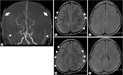 Fig. 3. a Four months after the second surgery, MRA demonstrates collateral vessels from the bilateral deep temporal arteries (arrowheads) and superficial temporal arteries (arrows) and reduced number of moyamoya vessels. b, d Preoperatively. c, e Postoperatively. The postoperative FLAIR images show resolution of the ivy sign bilaterally (arrowheads). FLAIR, fluid-attenuated inversion recovery.