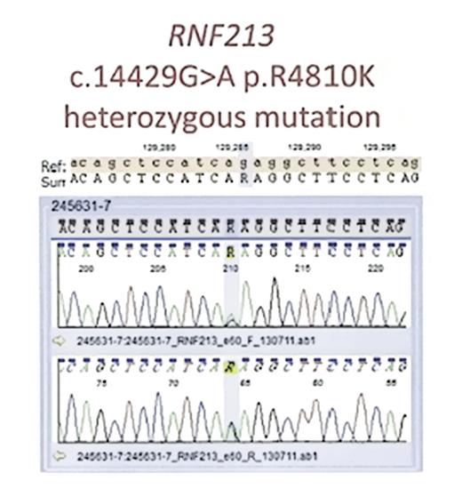 Fig. 4. Schematic result of the pyrosequencing of RNF213 A p.Arg4810Lys mutation in the RNF213 c.14429G&gt;A is observed.