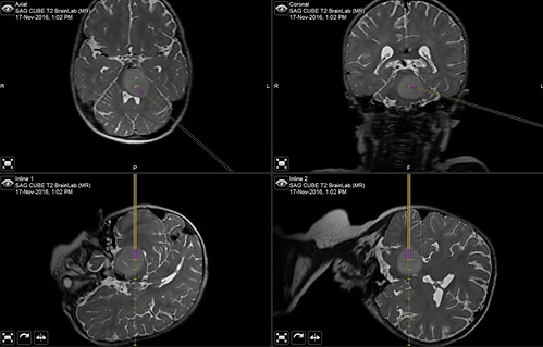  A representative biopsy trajectory used to access an infiltrating pontine glioma. The bottom panels show the actual trajectory through the cerebellum and middle cerebellar peduncle to reach the posterior portion of the mass. The magenta color shows the location of the aperture in the biopsy needle that is used to obtain the tissue core.