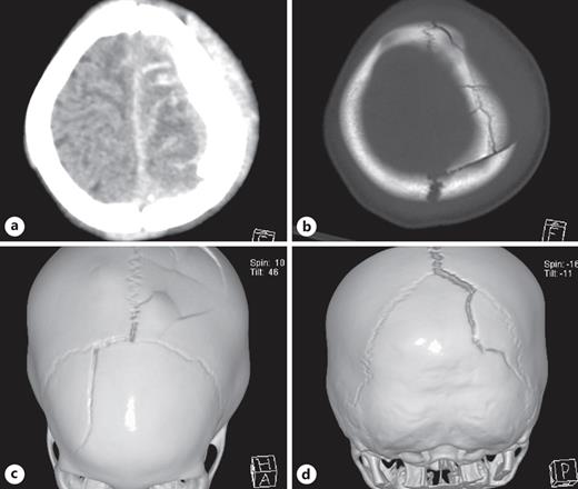 Non-contrast CT brain on arrival with (a) soft tissue and (b) bone window axial slices and (c, d) 3-D reconstruction of multiple skull fractures including a diastatic fracture.