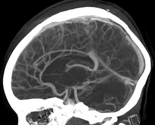 CT venogram with demonstration of SSS occlusion and engorgement of draining cerebral veins.