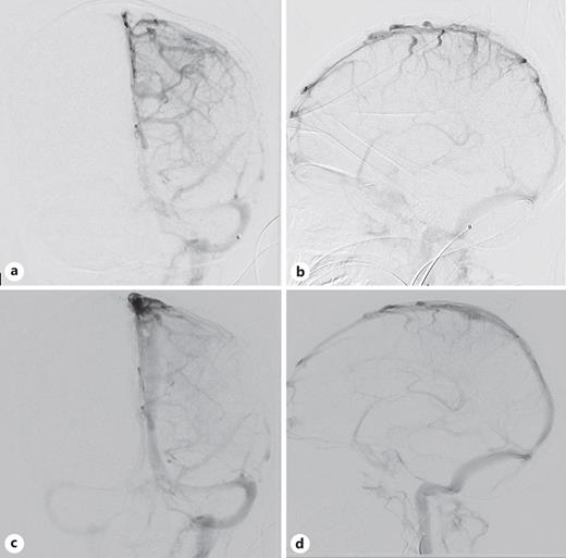 Pretreatment angiogram of left ICA injection (a) AP and (b) lateral views, and posttreatment left ICA injection (c) oblique AP and (d) lateral views.