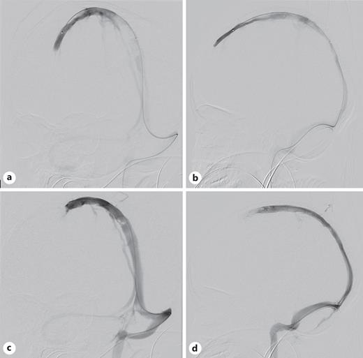 Pretreatment angiogram of SSS injection (a) AP and (b) lateral views, and posttreatment SSS injection (c) oblique AP and (d) lateral views.