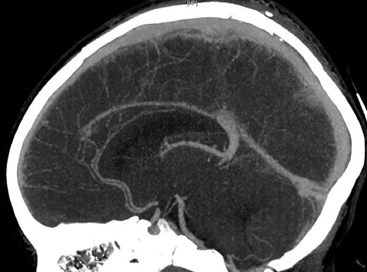 Delayed postoperative CT of the brain with contrast revealing patent SSS without intrinsic filling defect.