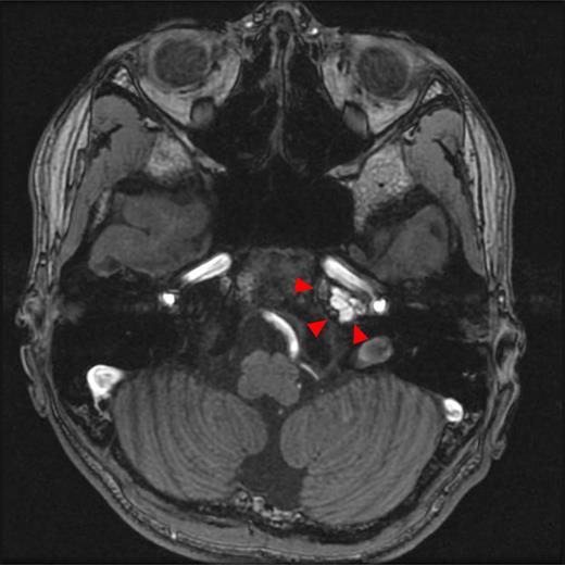 Initial magnetic resonance imaging (MRI). An axial section of T1-weighted MRI. High-intensity lesions are observed on T1-weighted images, measuring 22 mm mediolaterally and 11 mm anteroposteriorly (arrow).