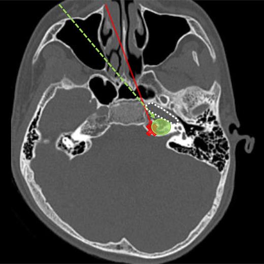 Axial computed tomography prior to the surgery. A transnasal endoscopic transsphenoidal approach (solid arrow) was considered challenging to fully explore the lesion due to the petrous part of the internal carotid artery (ICA: dotted circle). A combined CTM approach with a contralateral anterior maxillary sinus wall opening (dashed arrow) was chosen (solid circle).
