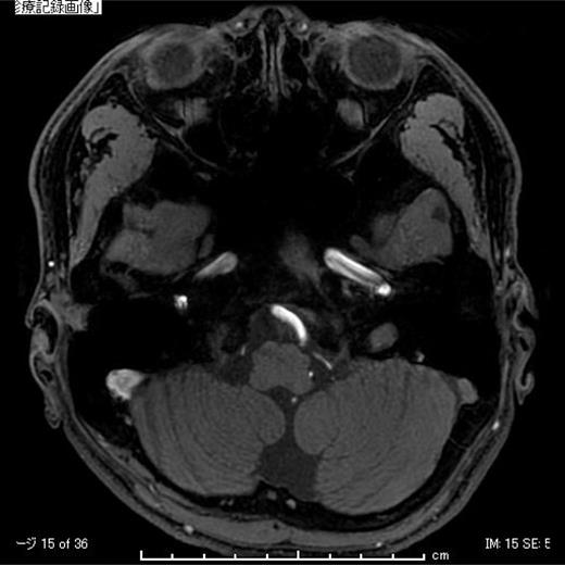 Postoperative magnetic resonance imaging (MRI). A postoperative axial section T1-weighted MRI. MRI demonstrated no recurrence at 46 months after the operation.