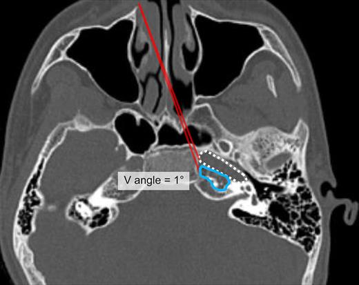 Computed tomography image showing the measurement of the V angle for the endoscopic transsphenoidal approach. The V angle is seen to be approximately 1° in this case. Red two line, V angle; solid circle, lesion; dotted line, petrous part of the ICA.