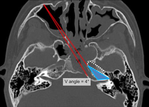 Computed tomography image showing the measurement of the V angle for the endoscopic CTM approach. The V angle is widened to 4°. Red two lines, V angle; solid triangle, unreachable area; dotted line, petrous part of the ICA.